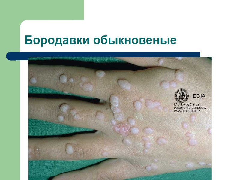 Бородавки обыкновеные